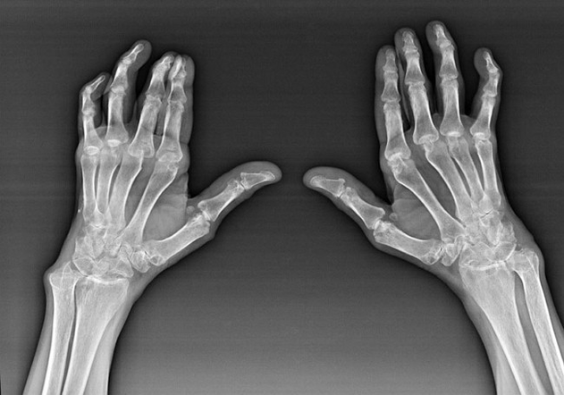 Sõrmede liigeste diagnostika