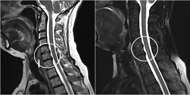Emakakaela lülisamba MRI osteokondroosi tunnustega